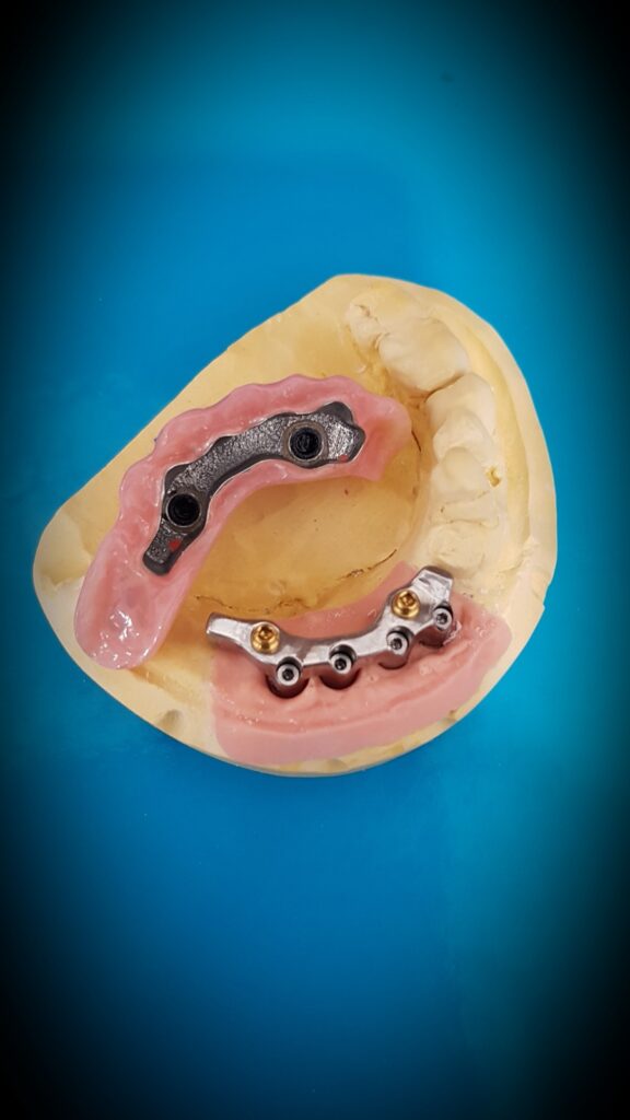Strutture implantari sul modello, dettaglio